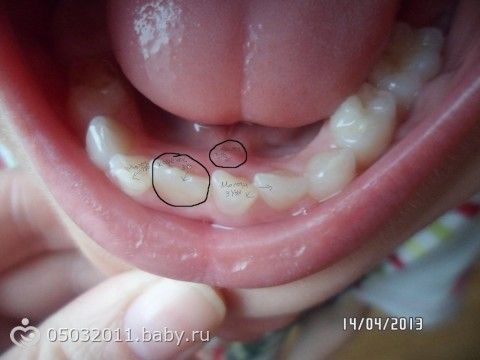 Молочные зубы вылезли криво 112