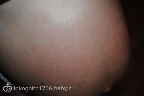 Как вылечить потницу у беременных 66