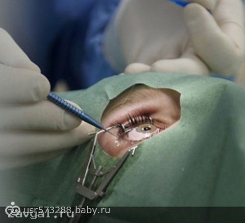 Когда можно делать лазерную коррекцию зрения детям Когда можно делать лазерную коррекцию зрения детям