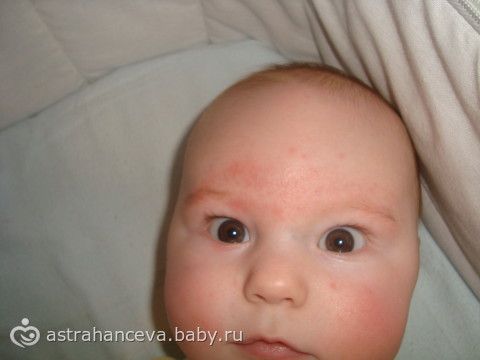 У ребёнка краснеют брови У ребёнка краснеют брови