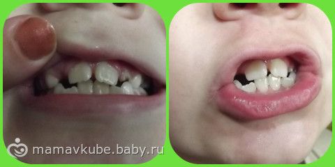 Пожелтение зубов у ребенка Пожелтение зубов у ребенка