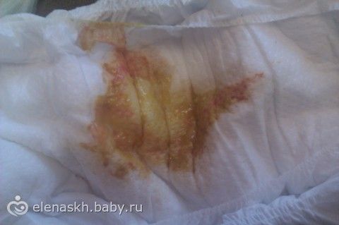 желтая слизь в кале у взрослого фото с пояснениями онлайн желтая слизь в кале у взрослого фото с пояснениями
