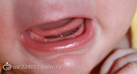 Чем помазать десна когда лезут зубы Чем помазать десна когда лезут зубы