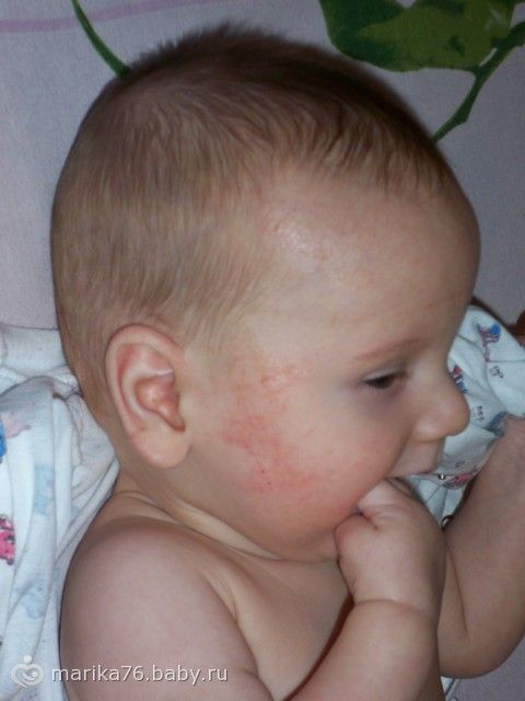 От аллергии ребенку 1 месяц