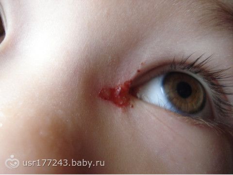 Через сколько дней появляется сыпь при ветрянке Через сколько дней появляется сыпь при ветрянке