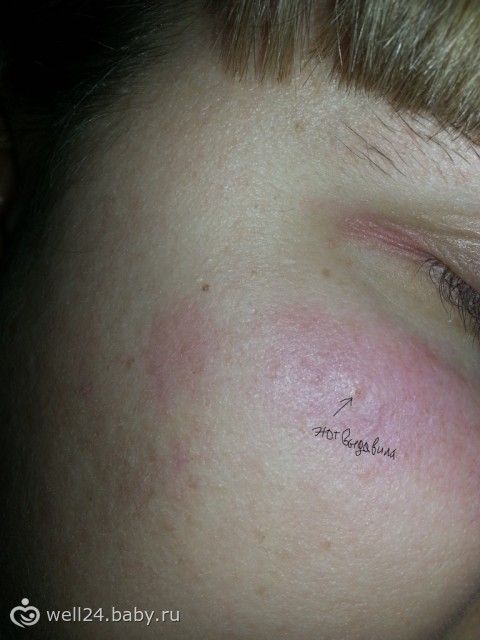 Если жировик под глазом в домашних условиях Если жировик под глазом в домашних условиях