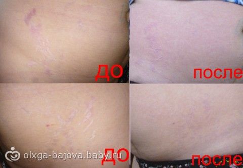 Кто убрал растяжки бодягой Кто убрал растяжки бодягой