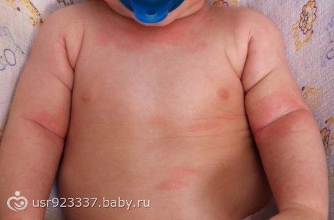 Тиосульфат натрия внутривенно отзывы псориаз