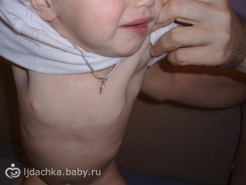 У дочки сыпь по всему телу У дочки сыпь по всему телу