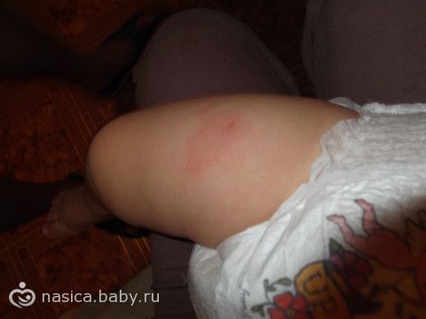 posle-traha-konets-opuhaet-i-gorit
