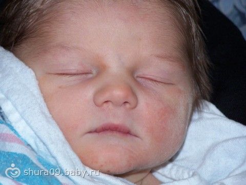 Синяя носогубная складка у ребенка 14 Синяя носогубная складка у ребенка 65