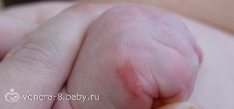 На руке у ребенка появилось красное пятно как ожог фото На руке у ребенка появилось красное пятно как ожог фото