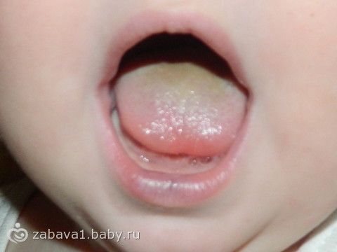 Желтый налет на языке у ребенка 1 год фото Желтый налет на языке у ребенка 1 год фото