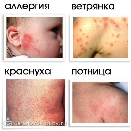неонатальный пустулез новорожденных фото онлайн неонатальный пустулез новорожденных фото