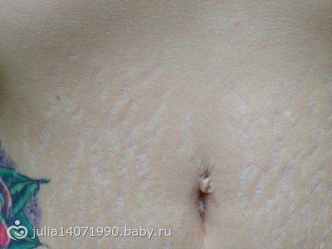 Ну жесть,ну(((про растяжки+фото