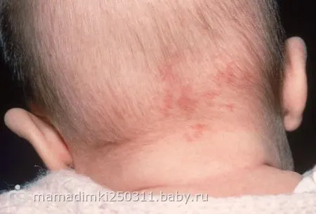Опрелости у ребенка: 9 самых частых причин. Чем лечить. - 7я.ру Опрелости у ребенка: 9 самых частых причин. Чем лечить. - 7я.ру