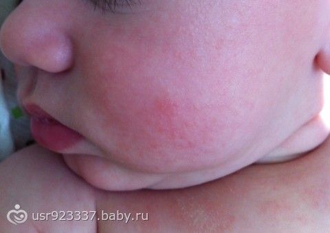 Отзывы о лома люкс псориаз